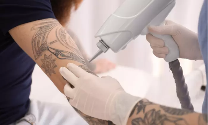 Up to 63% Off on Tattoo Removal at Bonnie Seeley Aesthetics - Primary Image