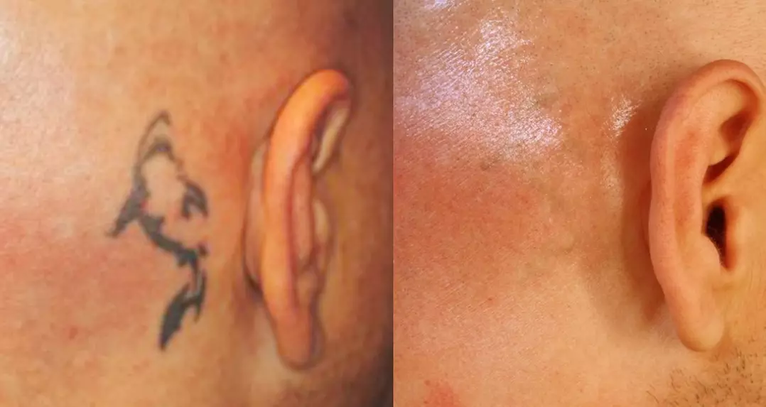 CPC Aesthetics: Enjoy (Up to 50% Off) Picosure Tattoo Removal Sessions on One Small, Medium or Large Area! - Primary Image