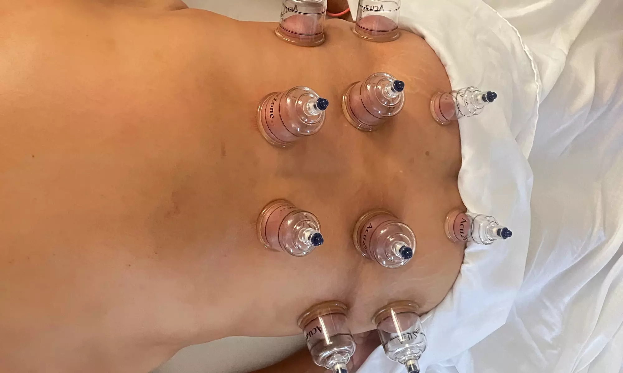 Up to 42% Off on Cupping at Sports Massage Spa - Second Medium