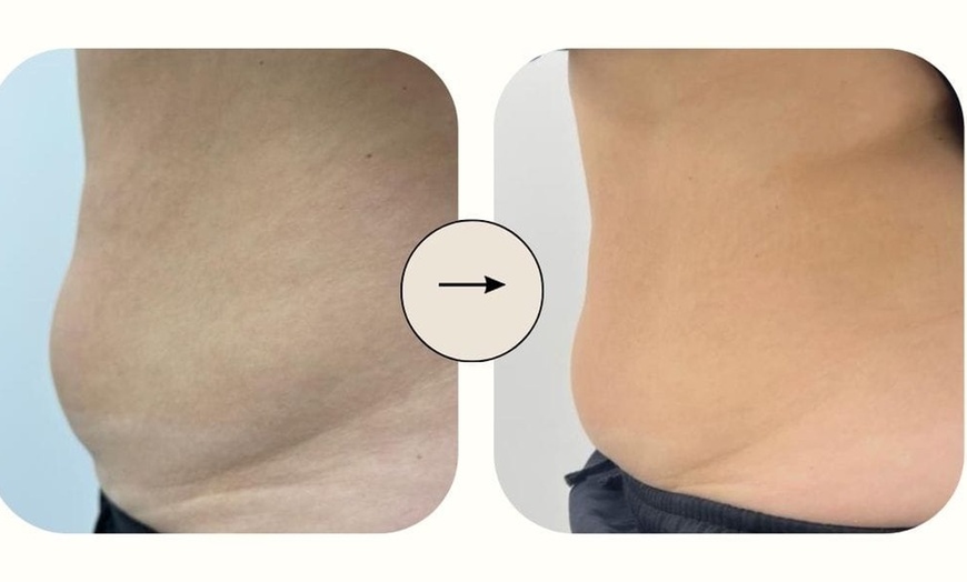 Image 10: CoolSculpting for Body or Chin with Laser Skin Tightening