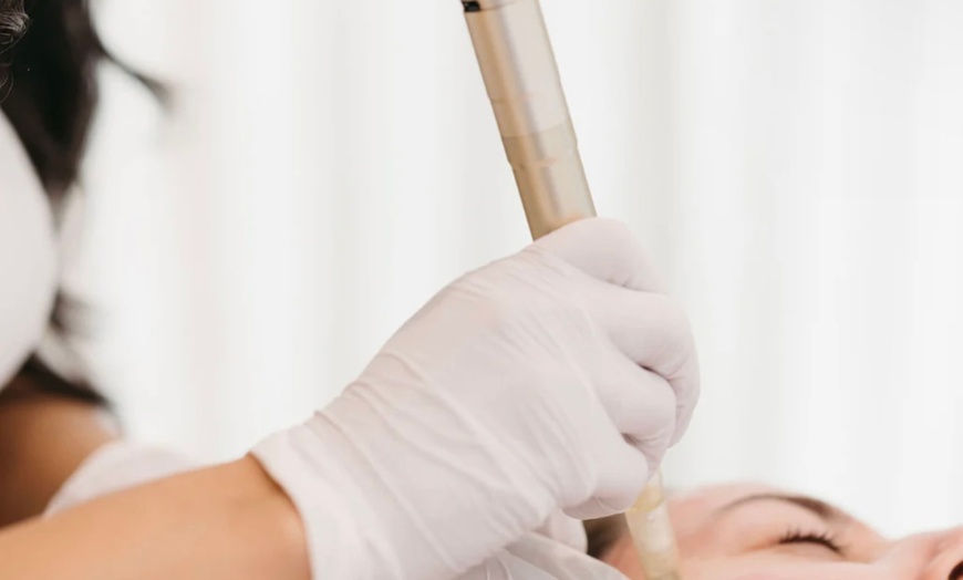Image 2: Up to 59% Off on Micro-Needling at World Of Kikka Salon