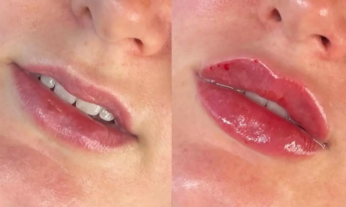 Enhance Your Lips with Russian Lip Enhancement Treatment