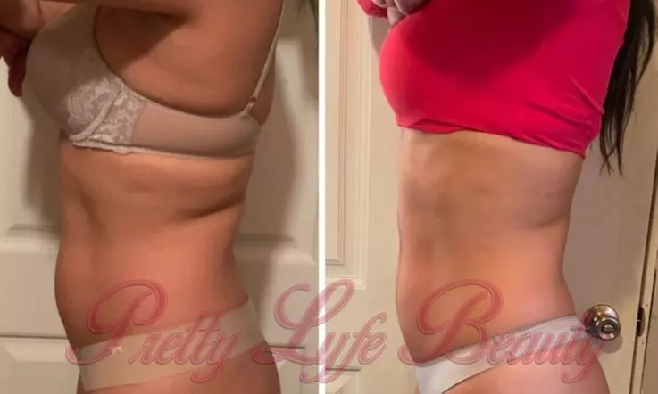 Up to 75% Off on Cavitation at Pretty Lyfe Esthetics