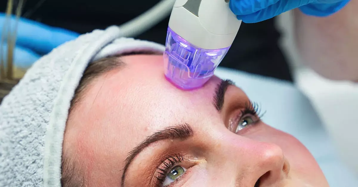 2, 60-minute RF Microneedling Sessions or 4, RF Microneedling Sessions