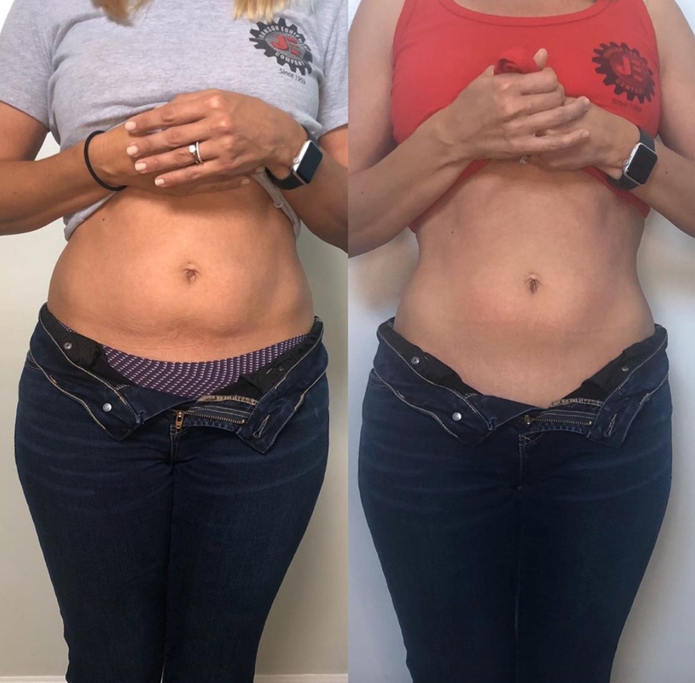 Up to 90% Off on Fat Reduction - Non-Branded at Shape Dallas