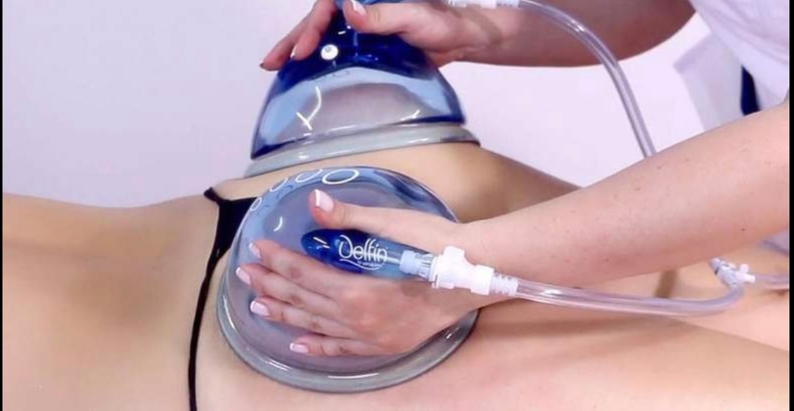 Non-surgical butt lift with multiple cupping session options