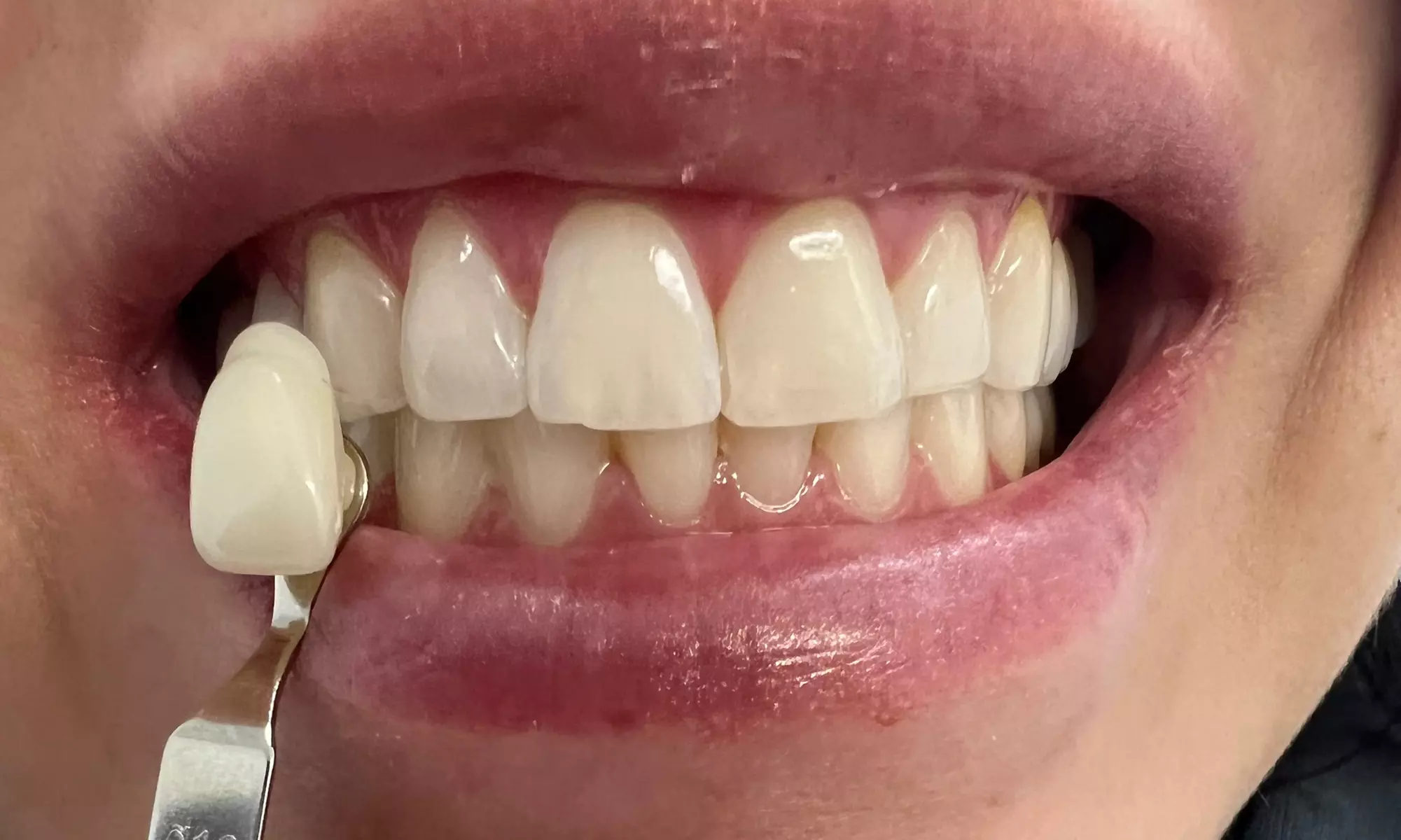 Up to 23% Off on Teeth Whitening at Smiles by Haley - Second Medium