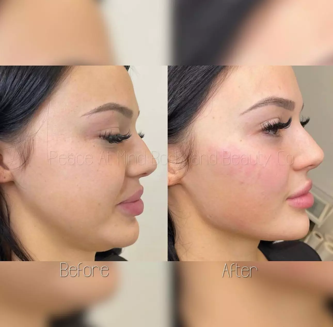 Up to 52% Off on Injection - Organic Filler at PMU By Christine - Primary Image