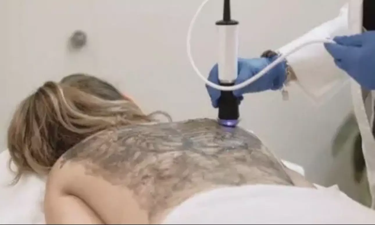 Experience the ultimate back refresh at Fresco MD Laser and Skin Clinic with Oxygeneo and ultrasound facials up to 48% off - Primary Image