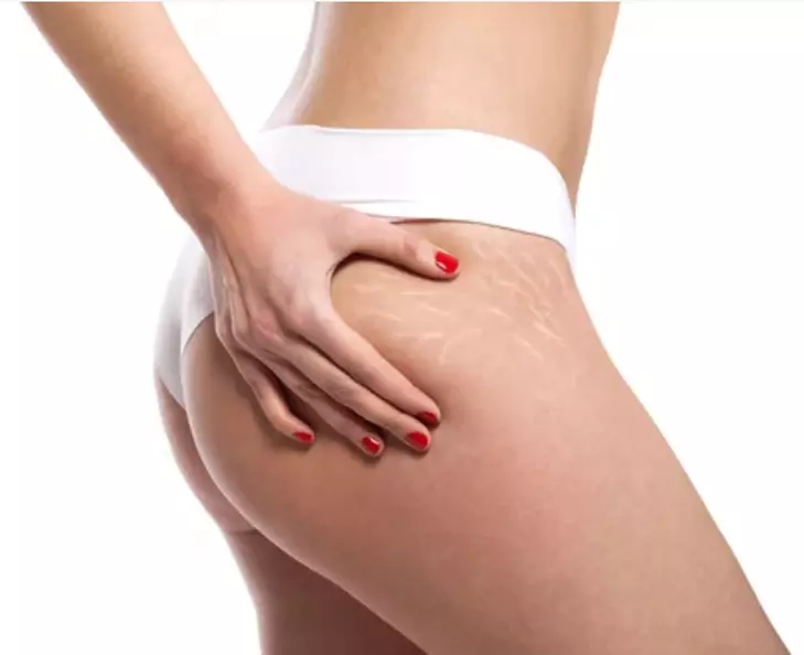 Inkified offers personalized stretch mark rejuvenation for love handles, thighs, shoulders, knees, stomach, and glutes with up to 50% off. - Primary Image