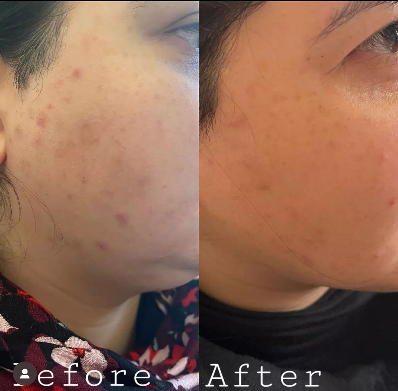 PRP / Platelet Rich Plasma / Vampire at Dr S Aesthetics