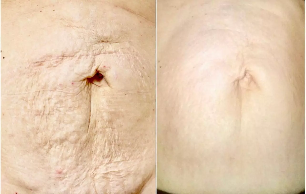 Up to 50% Off on Laser Skin Resurfacing-Unbranded at Wicked aesthetics