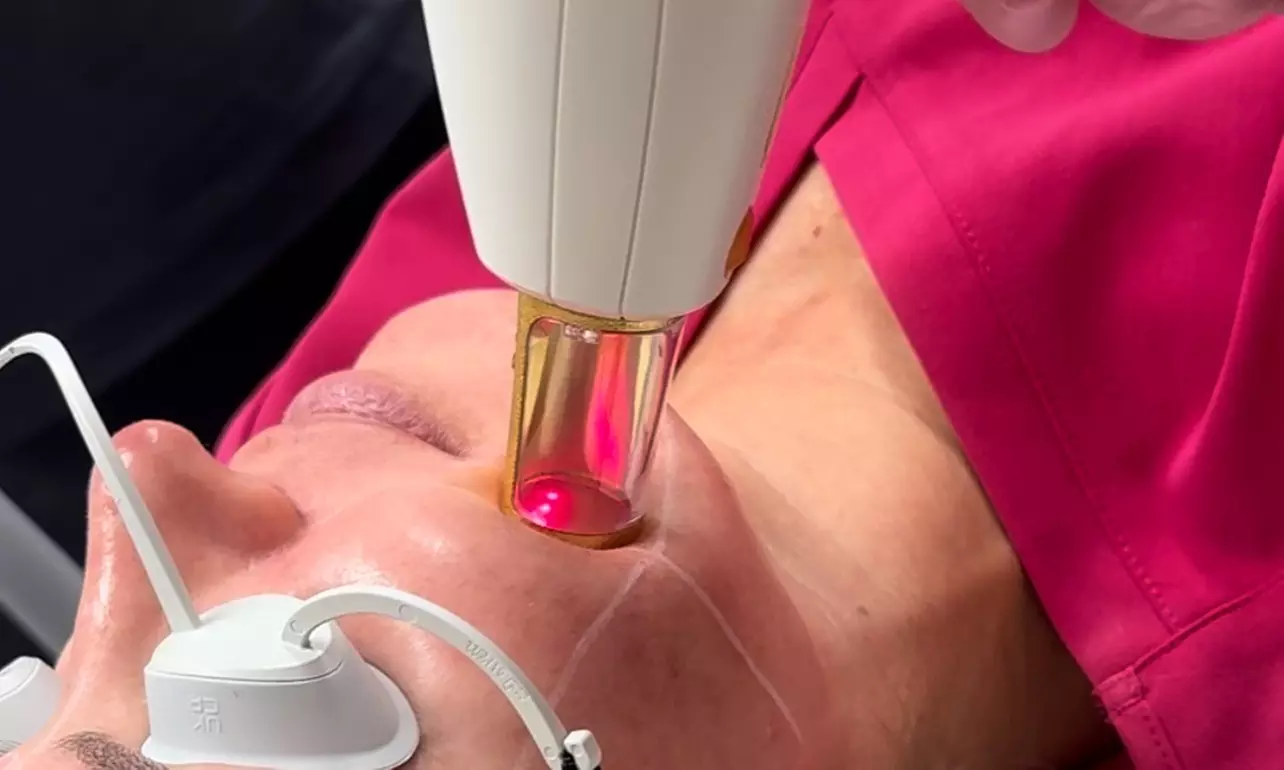 Up to 56% Off on IPL-Intense Pulse Light Therapy at Veda Aesthetics & Wellness - Primary Image