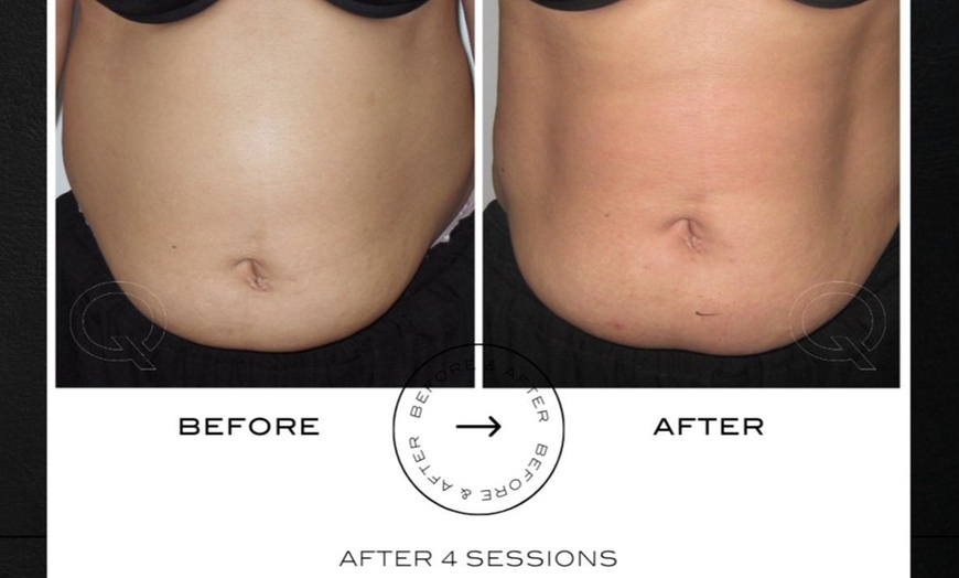 Image 6: Up to 73% Off on Ultrasonic Fat Reduction at LAMURE Aesthetic Clinic