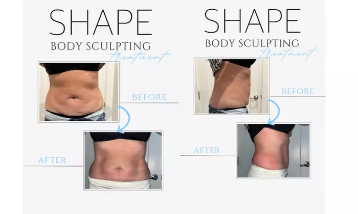 Experience Shape's body sculpting with packages of up to 10 treatments, and enjoy up to 80% off the original price - Second Medium