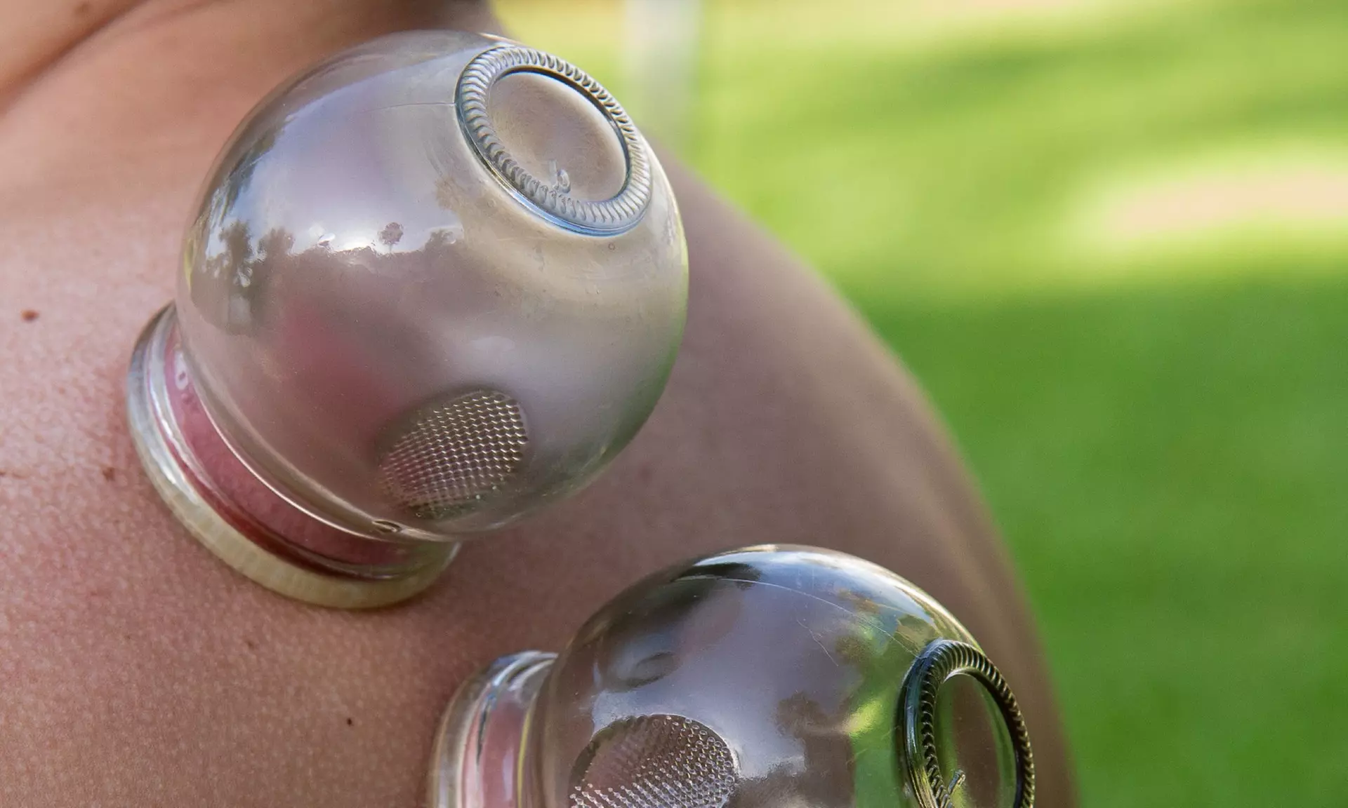 Experience a One-Hour Acupuncture Session for Pain Relief