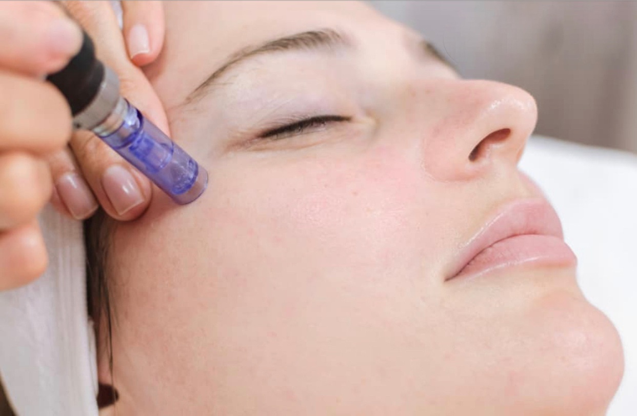 Get Smoother Skin with One or Three Micro-Needling Treatments