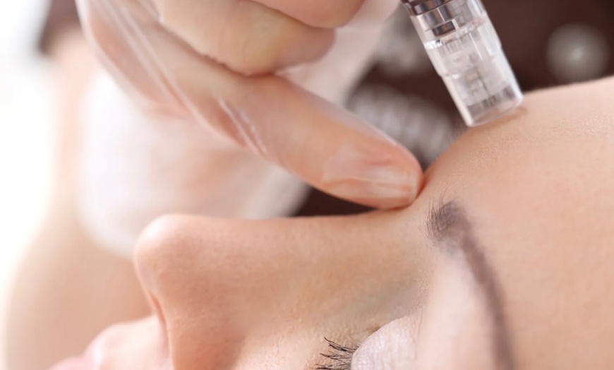 Image 1: Up to 59% Off on Micro-Needling at World Of Kikka Salon