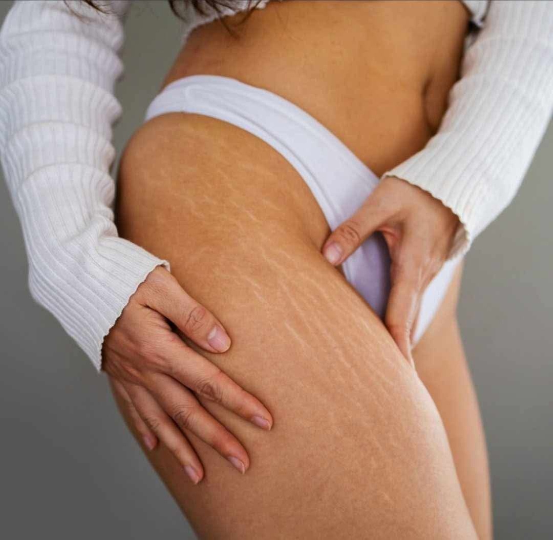 Stretch Mark or Scar Inkless Rejuvenation in Small or Large Areas