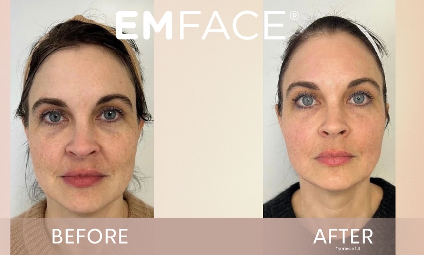 Image 1: Up to 37% Off on Facelift - Non-Surgical at Total Body Aesthetics