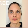 Image 1: Up to 37% Off on Facelift - Non-Surgical at Total Body Aesthetics