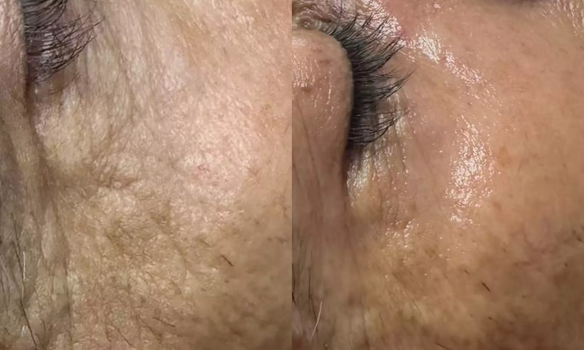 Up to 36% Off on HydraFacial