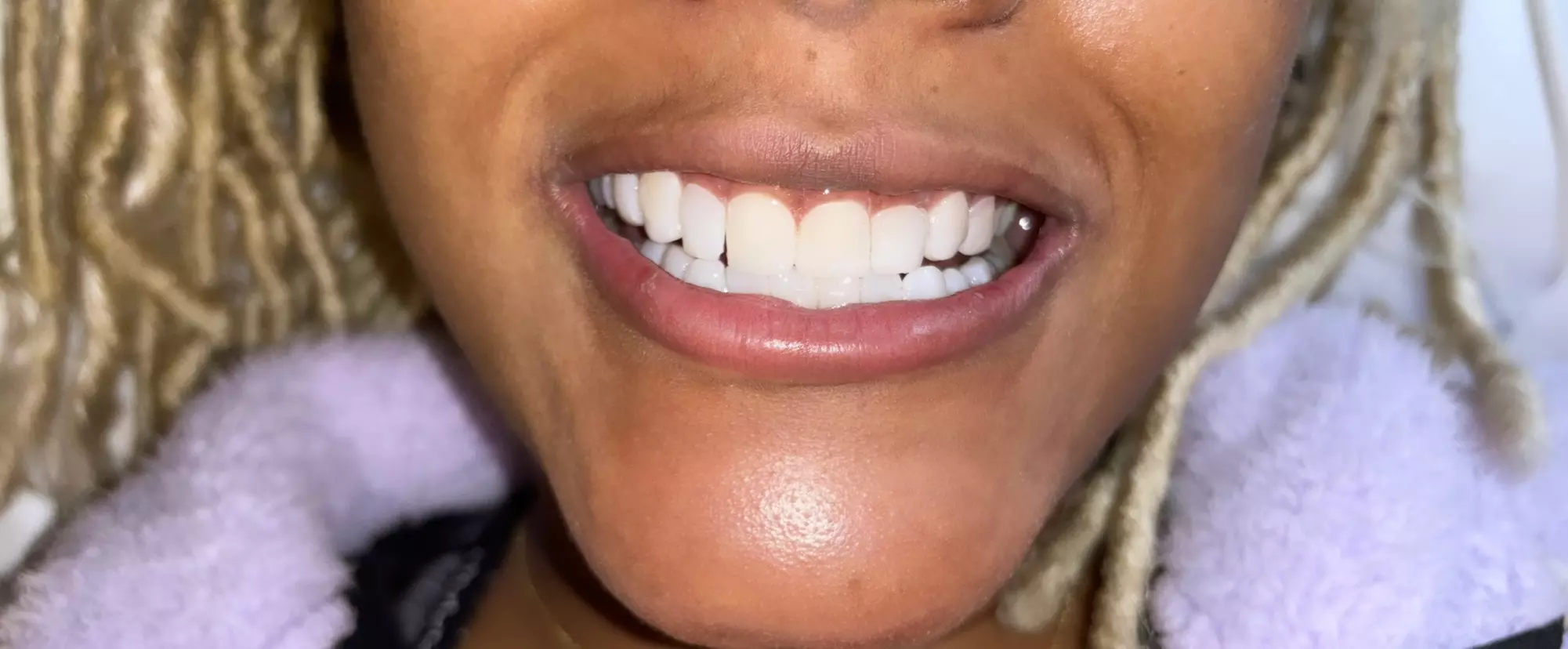 Experience Blush Smiles Atl's Full Resin Composite Veneers with up to 29% off, perfect for a smile makeover. - Primary Image