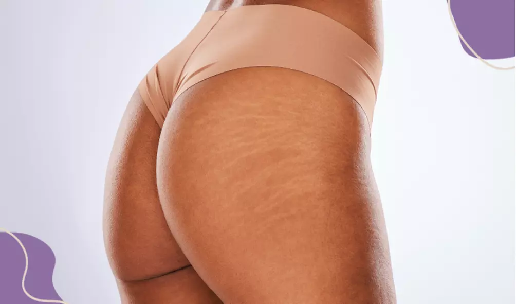 Transform your silhouette at Atlanta Body Sculpt with Therma-Lift sessions offering up to 76% off for a non-surgical butt lift - Primary Image