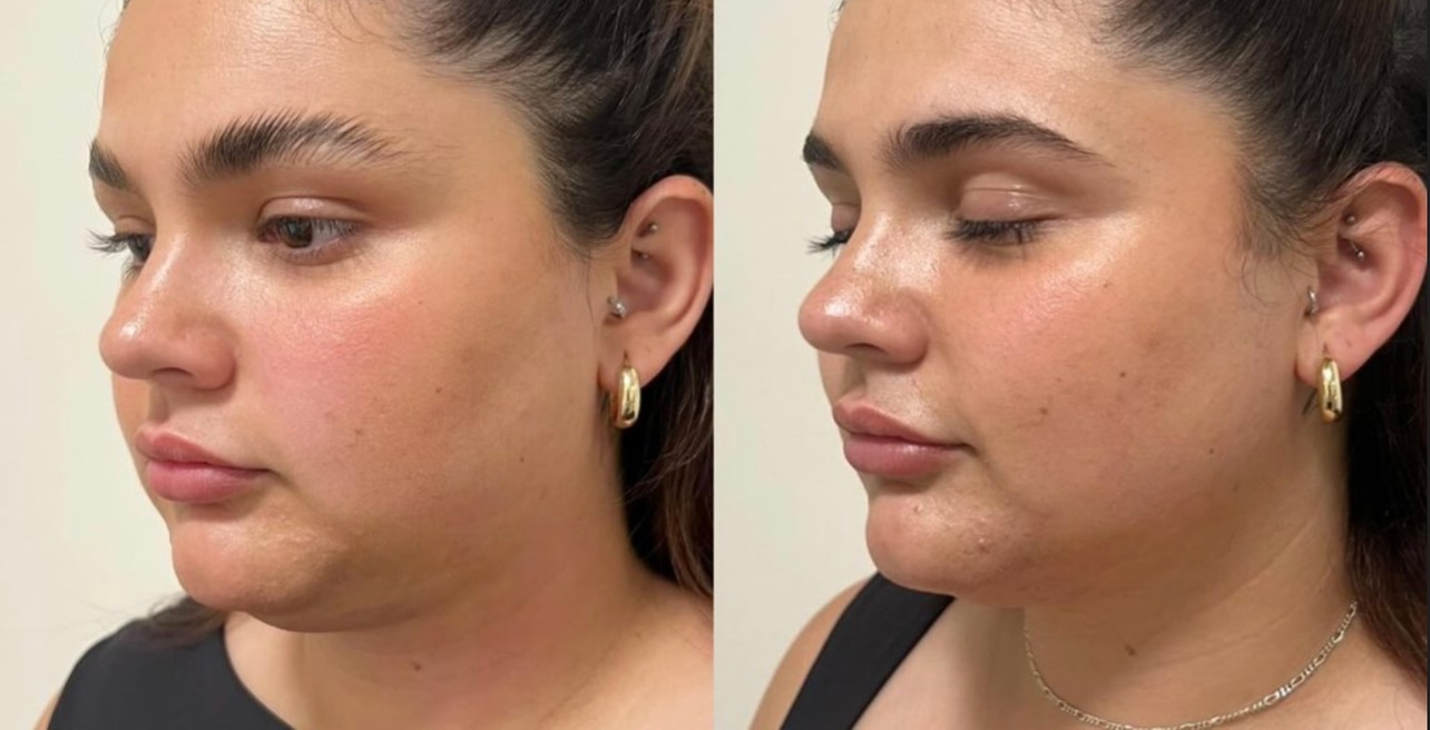 Elevate Your Look: Experience the Magic of Non-Surgical Lifts - Face!
