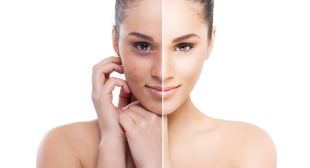 Up to 50% Off on Laser Peel with Carbon  