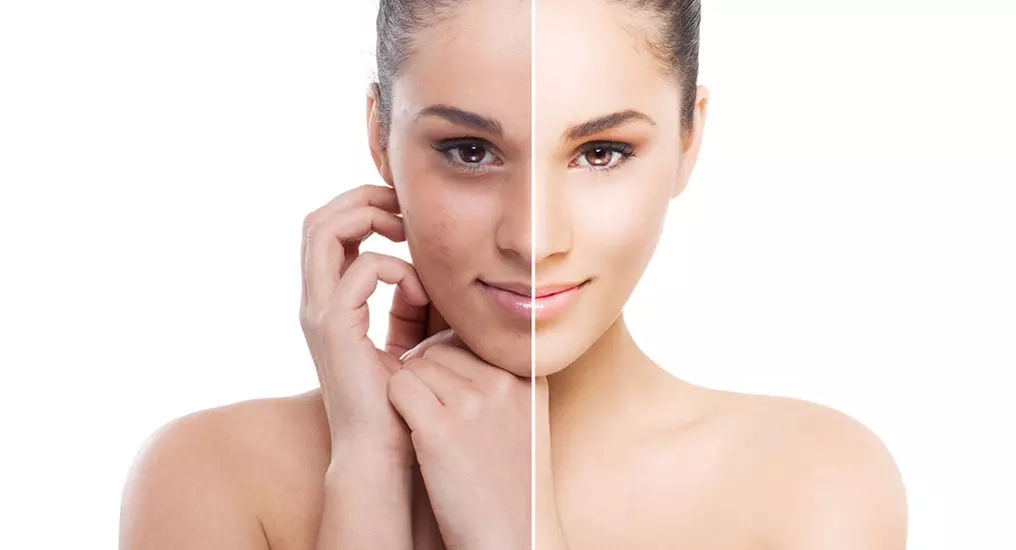 Laser Peel with Carbon at H.S. Medical Aesthetics & Wellness Center - Up to 55% Off - Primary Image
