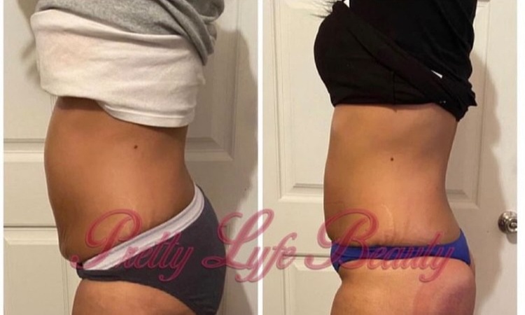 Up to 56% Off on Cryotherapy at Pretty Lyfe Esthetics