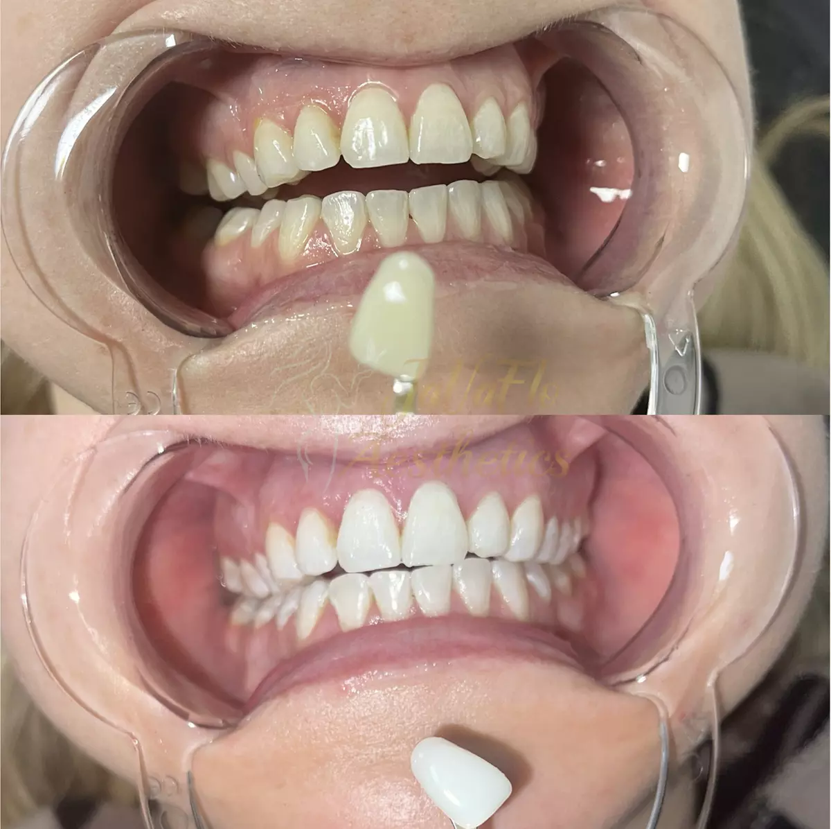 Up to 55% Off on Teeth Whitening at Javafloaesthetics
