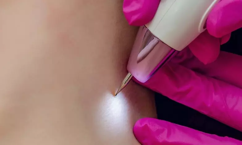 51% Off on Skin Tag removal - Primary Image