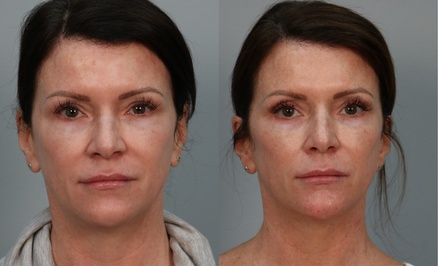 Face Contouring Non-Invasive, Small Area (Face, Mouth or Eyes) Radio Frequency: one session