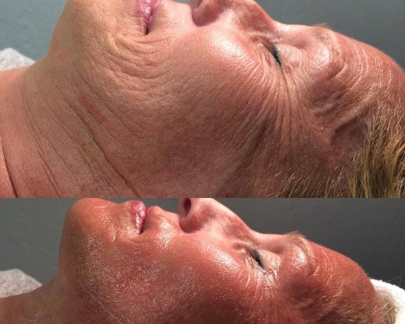 Experience whole-body cryotherapy with facial options