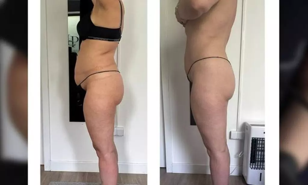 Liposukcja Kawitacyjna, masaż próżniowy z RF lub masaż miodowy