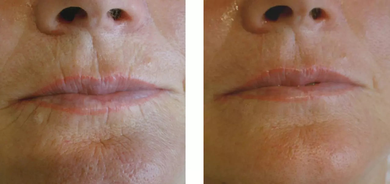 Experience Chuck Georgies Skincare and Wellness NanoFusion Facials, including Needle Free Micro Needling & Collagen Mask, with up to 64% off - Second Medium