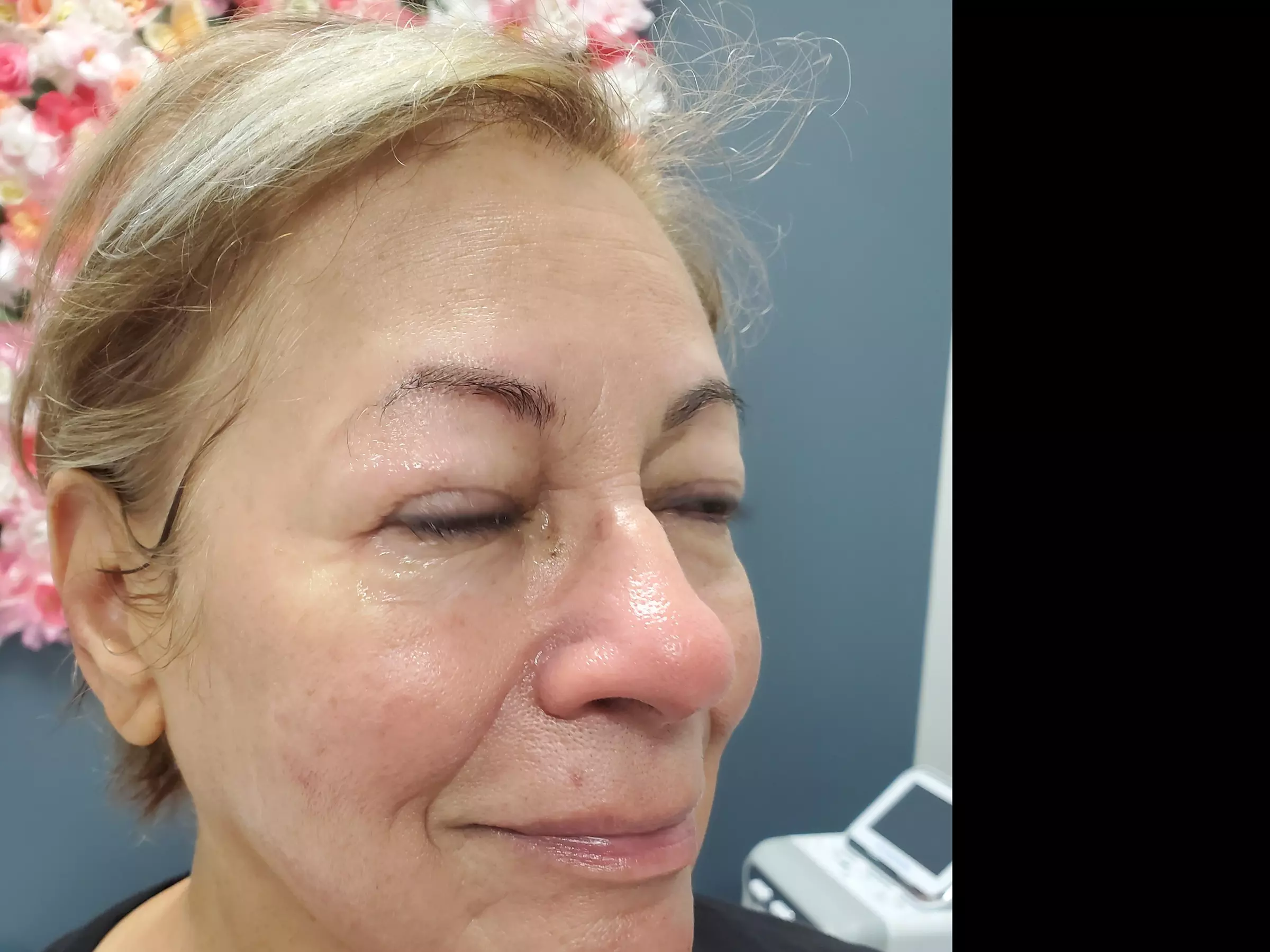 Up to 30% Off on Facial - Fruit Acid Peel at Adorn Beauty by Syeda - Primary Image