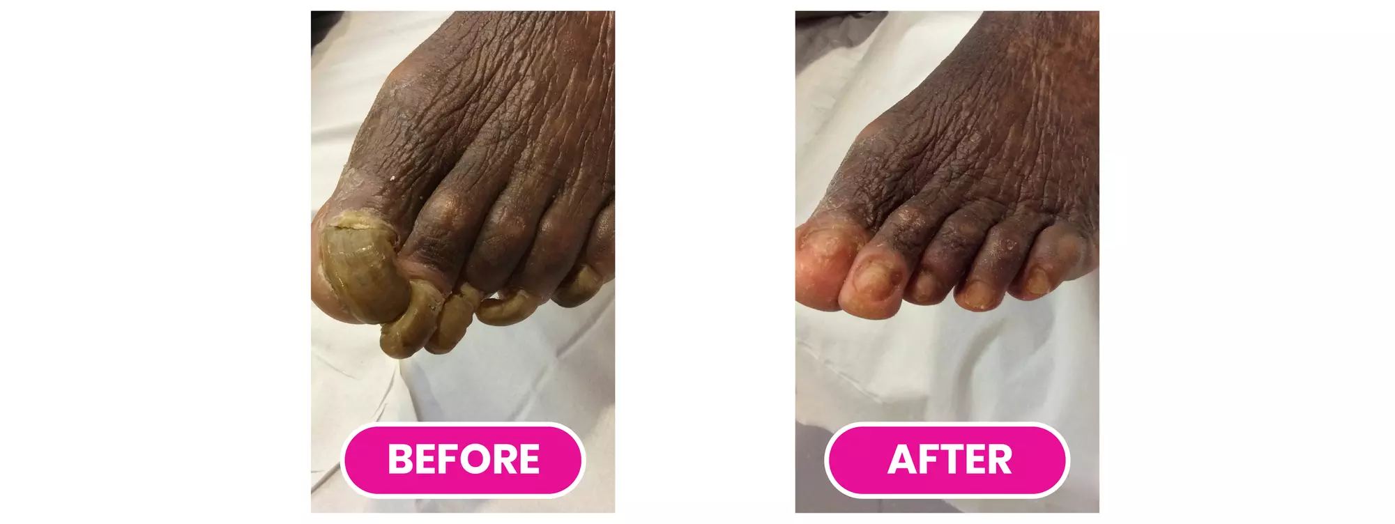 Toenail Changes? Get an Expert Diagnosis! 
(Up to 87%)