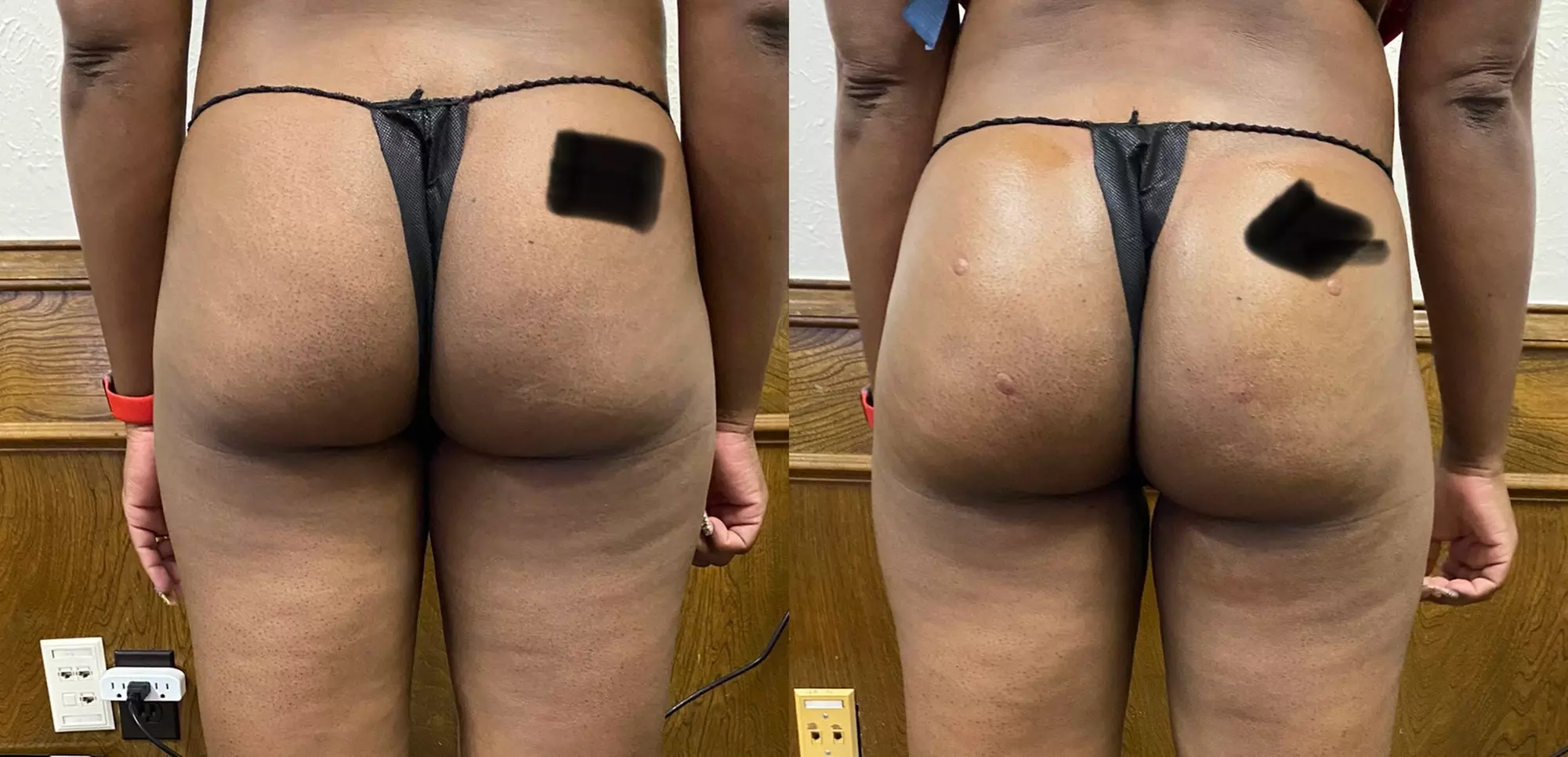 Non-Surgical Butt Lift Sessions for a Firmer Silhouette