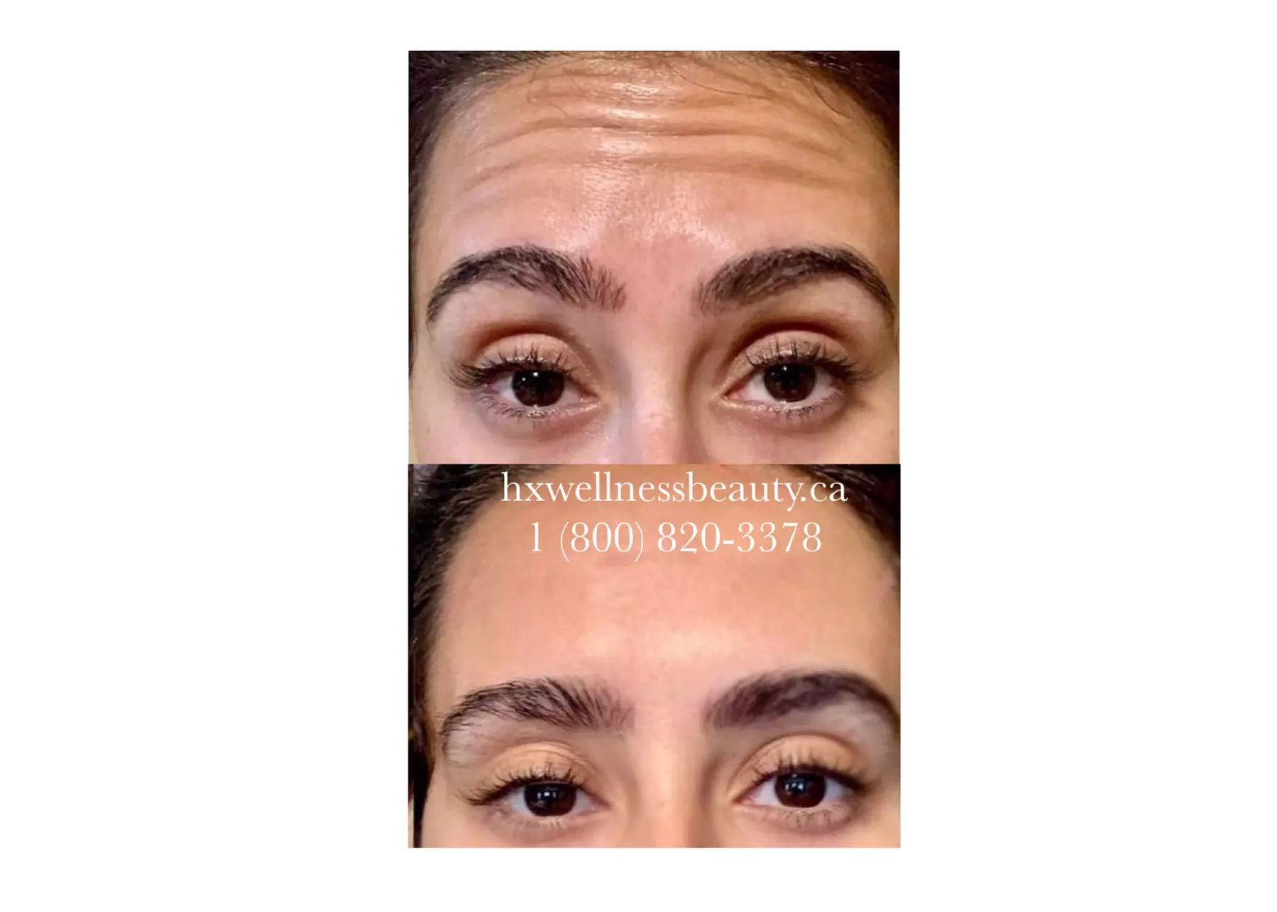 Up to 10% Off on Injection - Botox at HXWELLNESSBEAUTYSALON