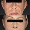 Image 1: Revitalize with MORPHEUS 8/ Sylfirm X Face Skin Tightening Treatment