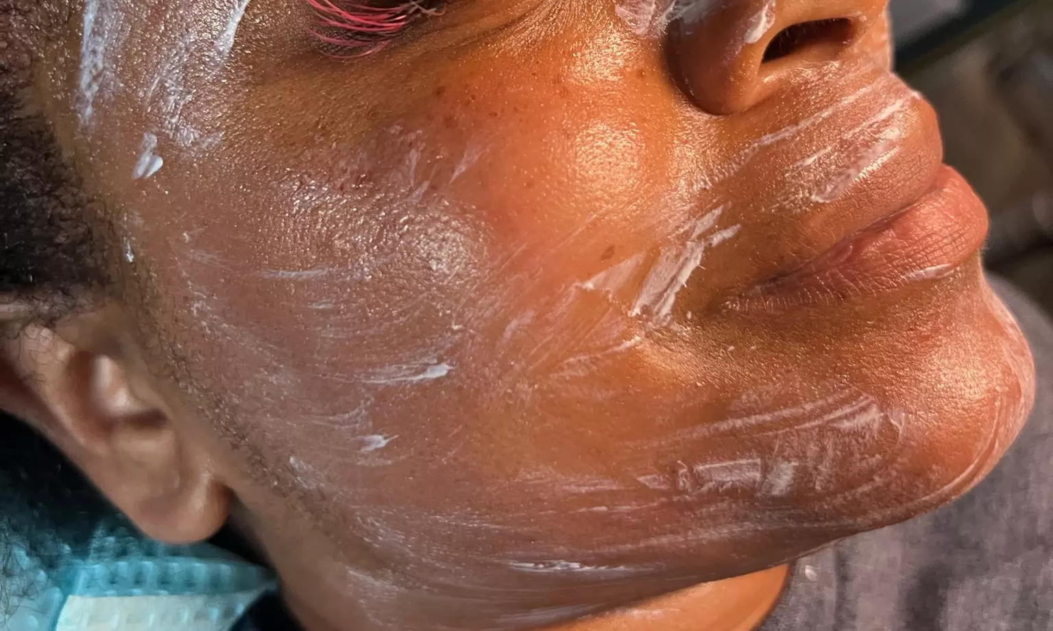 Up to 48% Off on Chemical Peel at The Unlimited Clinic - Second Medium