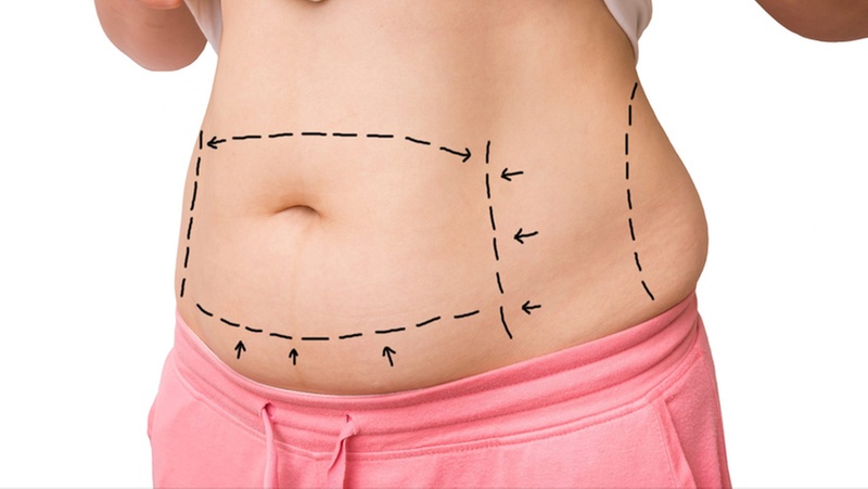 Get Radio Frequency Tightening and Fat Cavitation Treatments