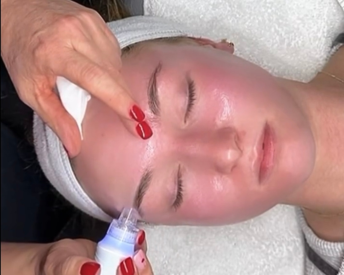 HydraFacial Treatment with Dermaplaning Option for Glowing Skin