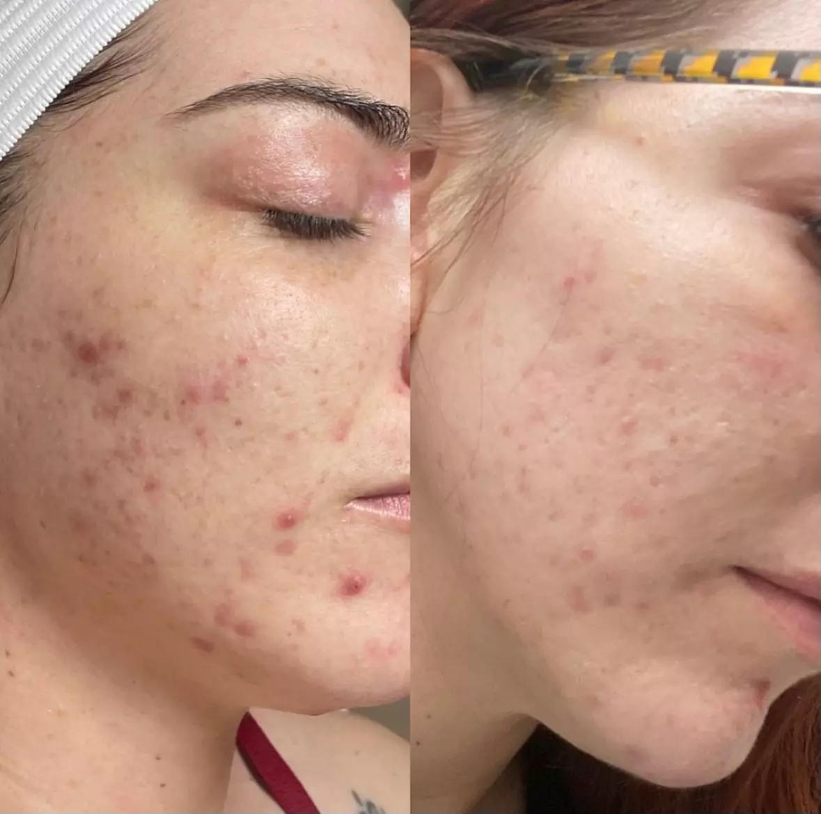 Up to 47% Off on Acne Treatment at Complexion Esthetician