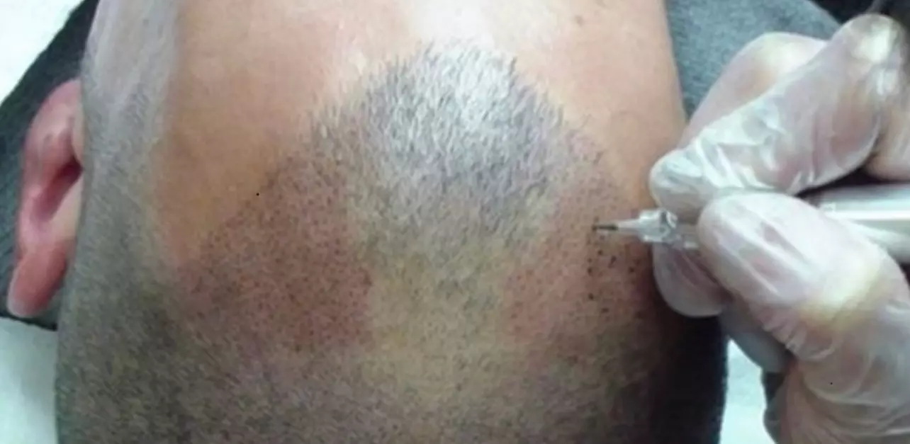 Up to 70% Off on Hair Restoration - Non-Surgical at Palm Springs SMP - Primary Image