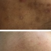 Image 2: Refresh Your Skin w/ 1 or 3 Teen Acne Laser Skin Resurfacing Sessions 