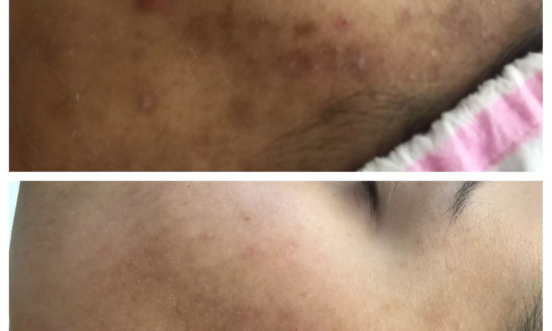 Refresh Your Skin w/ 1 or 3 Teen Acne Laser Skin Resurfacing Sessions